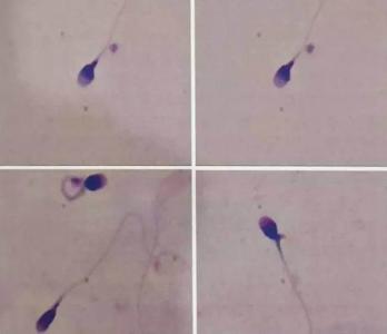 专家带您探寻膀胱炎病因